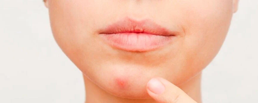 Epilazione laser: effetti collaterali, petecchie e brufoli